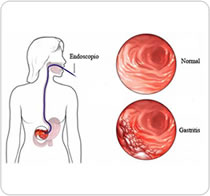 Gastric Ulcers Surgery In Anand