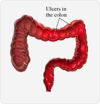 Gastric Ulcers Surgery In Anand