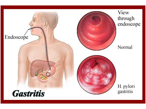 Best Ulcer Treatment In Anand