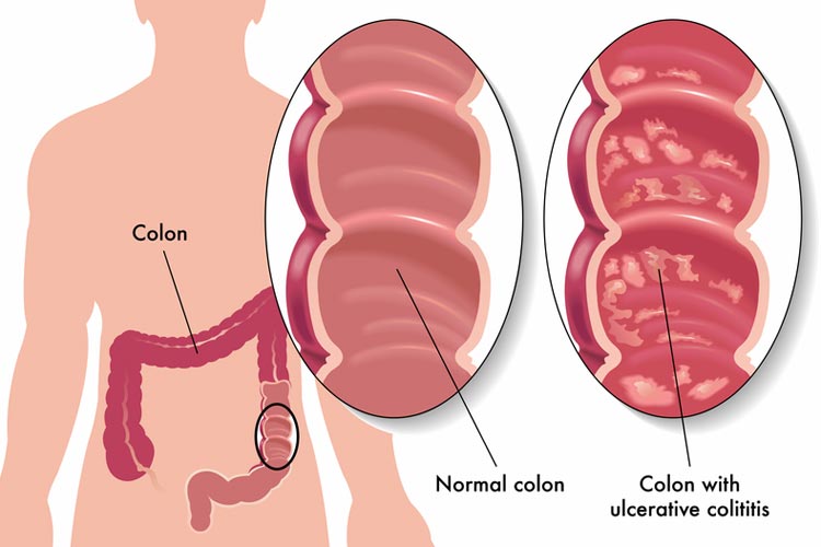 Best Ulcer Treatment In Anand