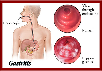 Gastritis Treatment In Anand 